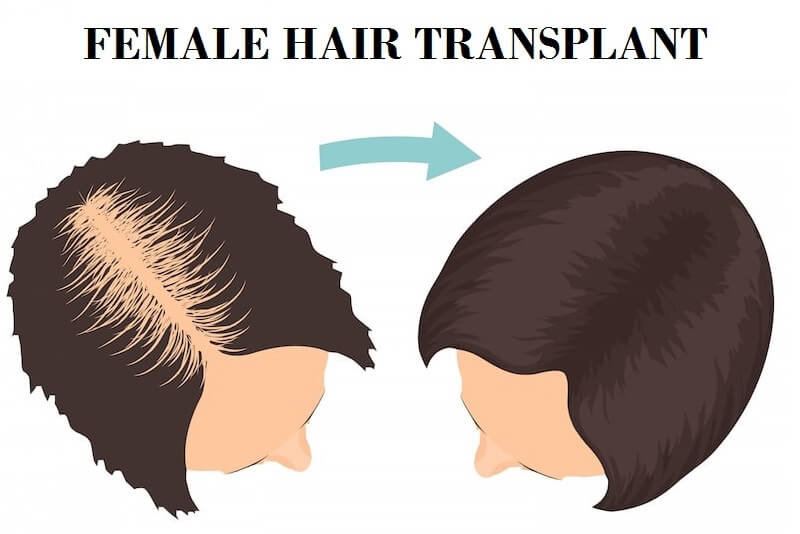 Female Hair Transplant cost in Delhi