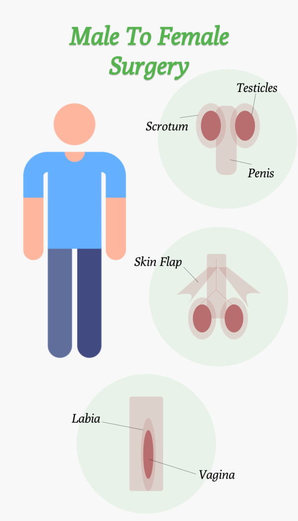 male to female surgery