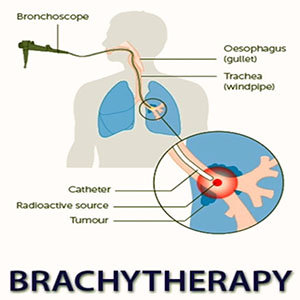 Brachytherapy