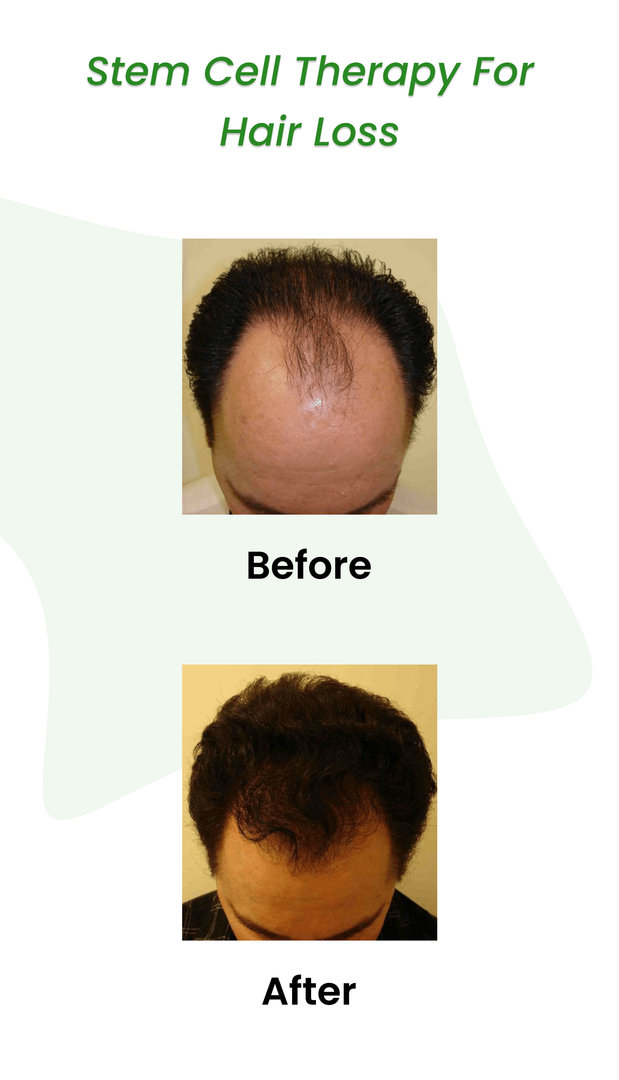 Stem Cell Hair Transplant  Frequently Asked Questions