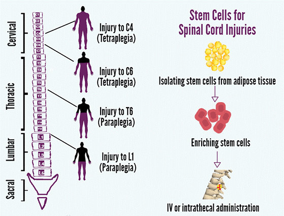 Spine Surgery