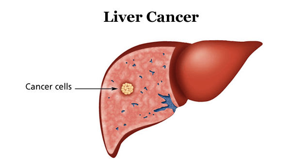 Liver-cancer
