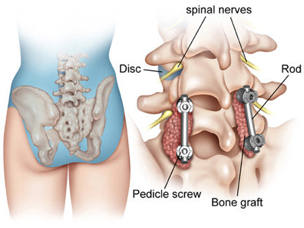 Transforaminal body part interbody fusion (TLIF)