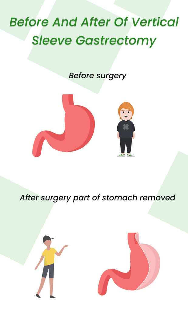 Before and After of Vertical Sleeve Gastrectomy in Turkey