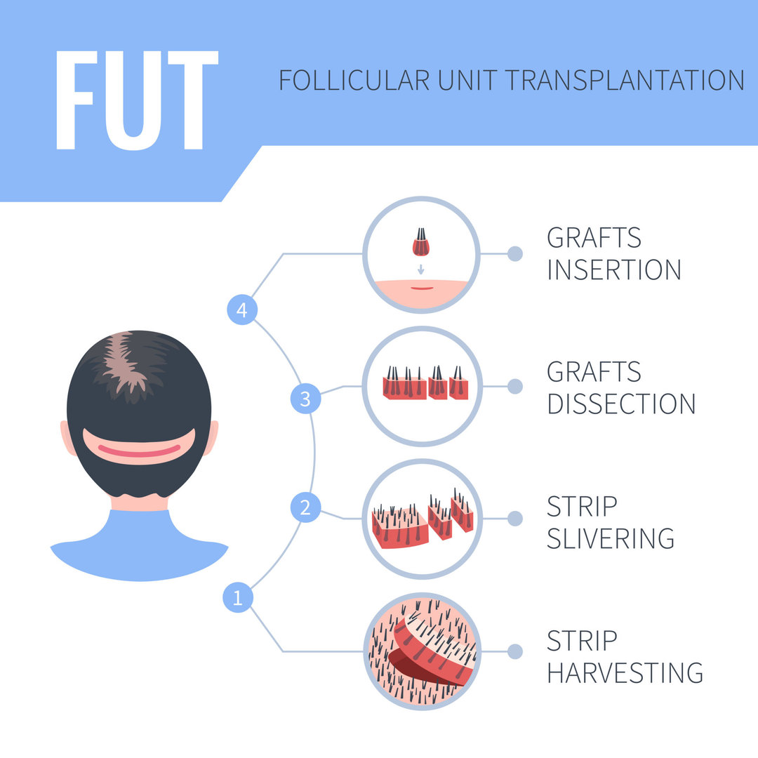 Hair Transplant Results in Chennai Before After Photos  DermaClinix