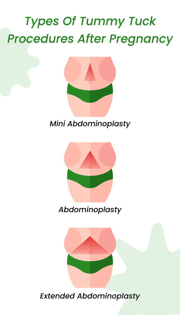 Types of Tummy Tuck Procedures After Pregnancy