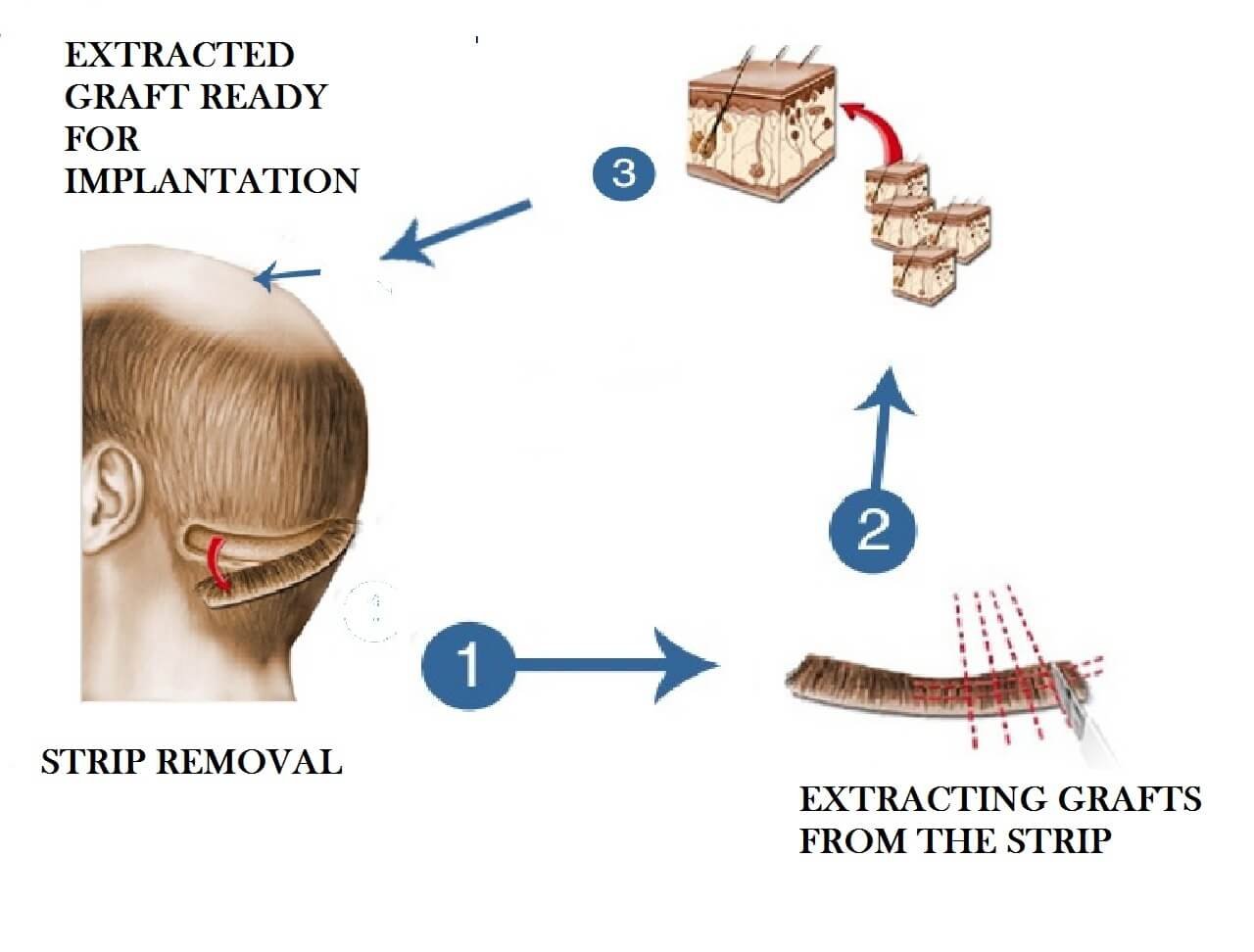 FUT (Follicular Unit Transplantation) Technique used in Delhi