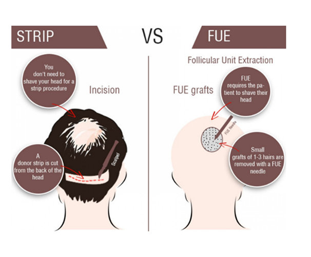 Differecne between FUT & FUE