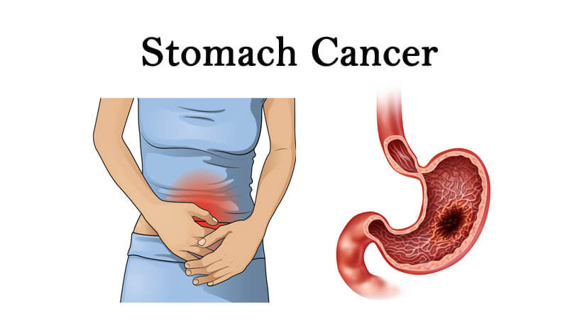 Stomach-cancer