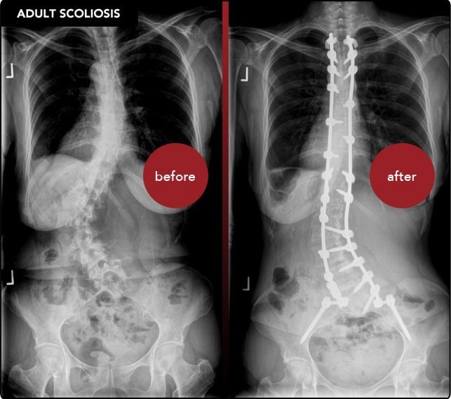 Scoliosis