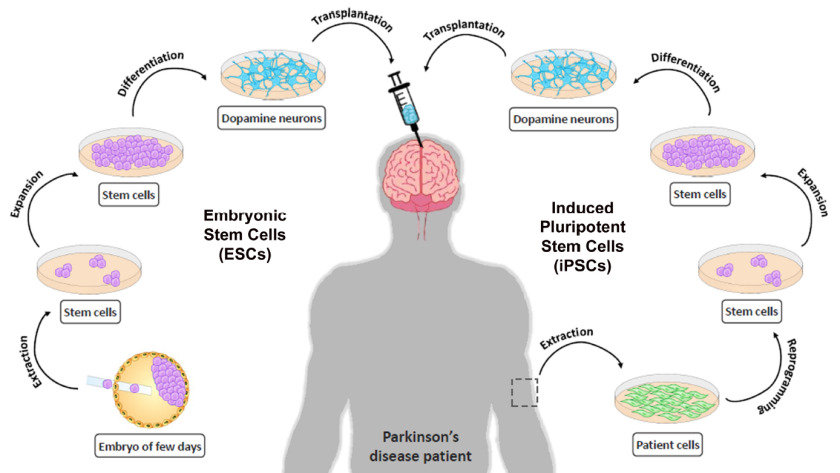 Parkinson's Disease