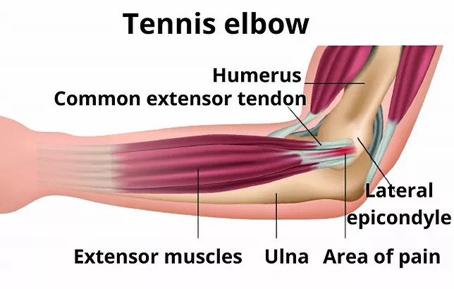 Tennis Elbow