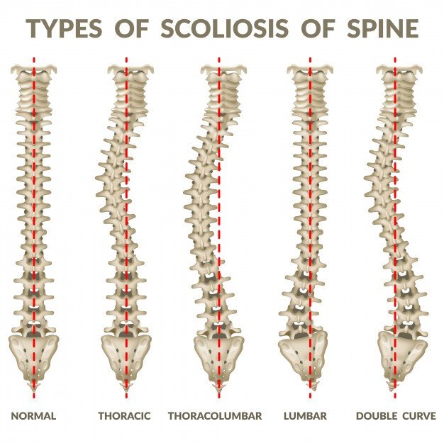 types of scoliosis of spine
