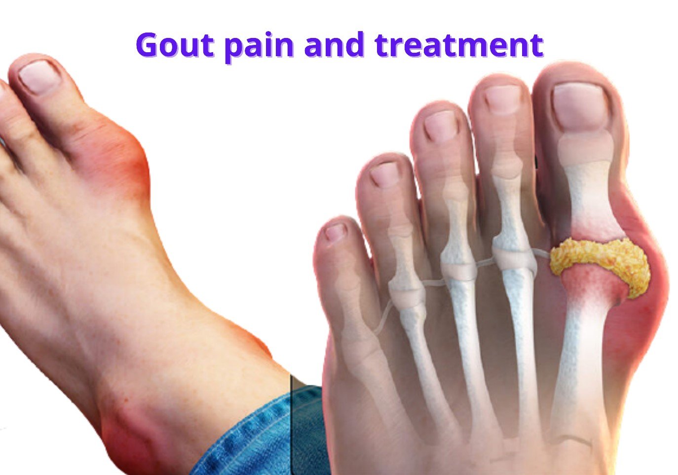 Gout Treatment Gout Treatment