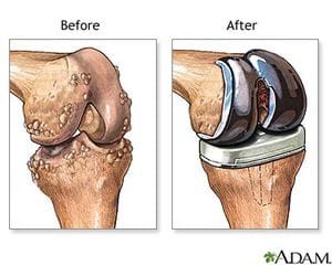 knee replacement