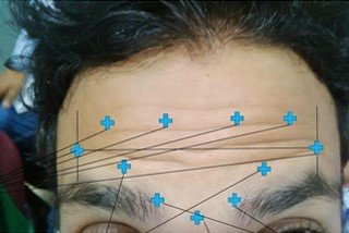 Forehead anti wrinkle treatment Forehead anti wrinkle treatment