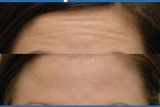 Anti wrinkle treatment Anti wrinkle treatment