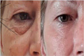 Skin tightening treatment Skin tightening treatment