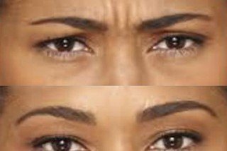 Forehead anti wrinkle treatment Forehead anti wrinkle treatment