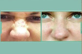 Maxillofacial surgery for nose Maxillofacial surgery for nose