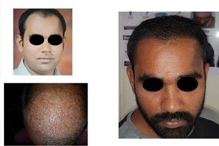 Scalp hair transplantation Scalp hair transplantation