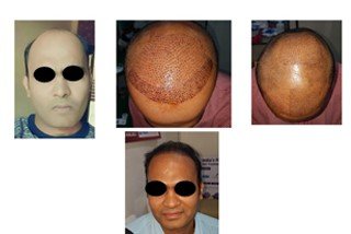 hair transplantation hair transplantation