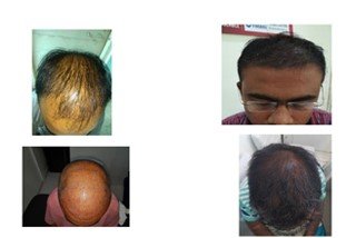 PRP treatment for scalp hair PRP treatment for scalp hair