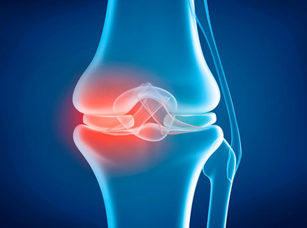 Knee Replacement Procedure