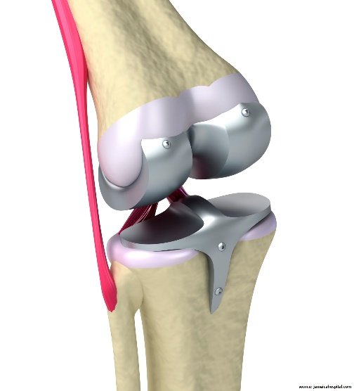 Knee Replacement