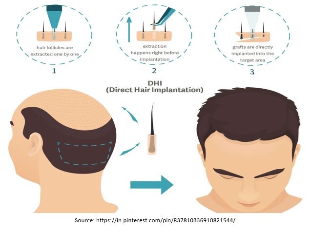 Female Hair Transplant in Vashi, Navi Mumbai | Dr Audumbar Borgaonkar Female Hair Transplant in Vashi, Navi Mumbai | Dr Audumbar Borgaonkar