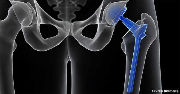 hip replacement surgery