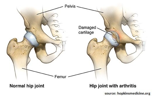 hip replacement
