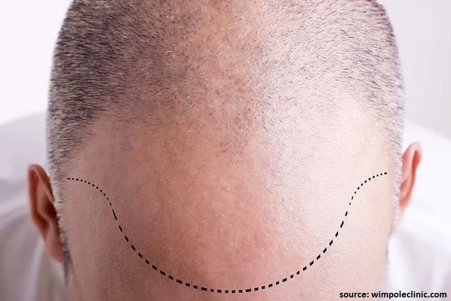 hair transplant