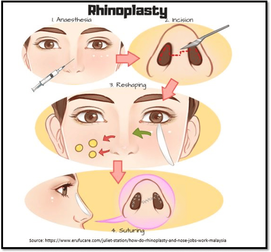 Types of Rhinoplasty