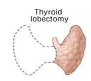 Thyroid lobectomy