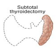 subtotal thyroidectomy