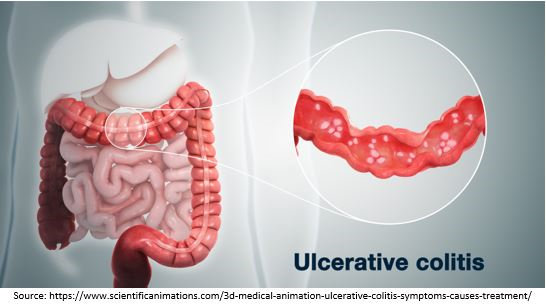 Ulcerative Colitis Treatment