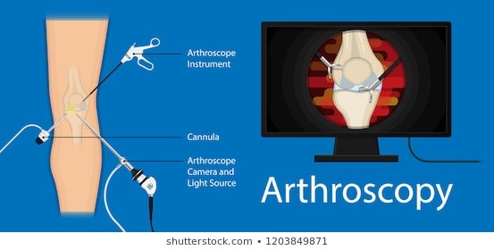 Arthroscopic Images, Stock Photos & Vectors | Shutterstock