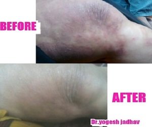 Before and after images of treatment done by Dr Yogesh jadhav