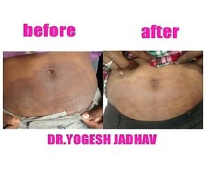 Before and after images of treatment done by Dr Yogesh jadhav