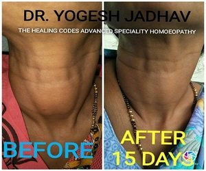 Before and after images of thyroid treatment done by Dr Yogesh jadhav