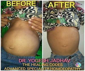 Before and after images of treatment done by Dr Yogesh jadhav