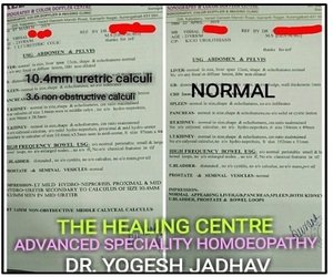 Before and after reasult of a patient treated by dr Yogesh jadhav, Advanced Speciality Homeopathy clinic