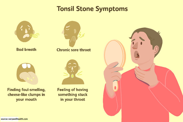 Symptoms of Tonsil Stones
