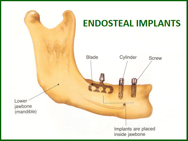 endosteal implant