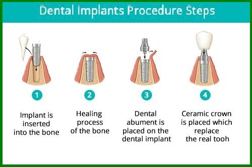procedure of dental implant