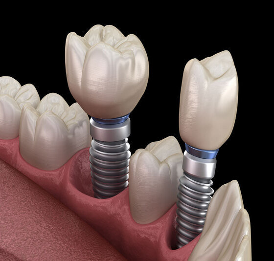 Dental implant - Dental clinic in Navi Mumbai