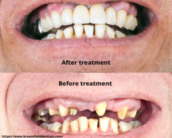 Full mouth restoration - Dental clinic in Navi Mumbai
