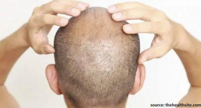 remove Scabs after a Hair Transplant
