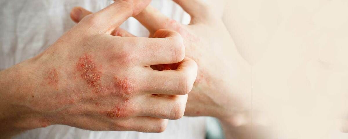 Eczema Treatment in Aurangabad